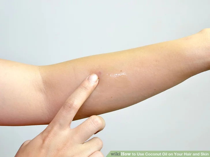 Step 3 Apply coconut oil to  reduce the appearance of scars.